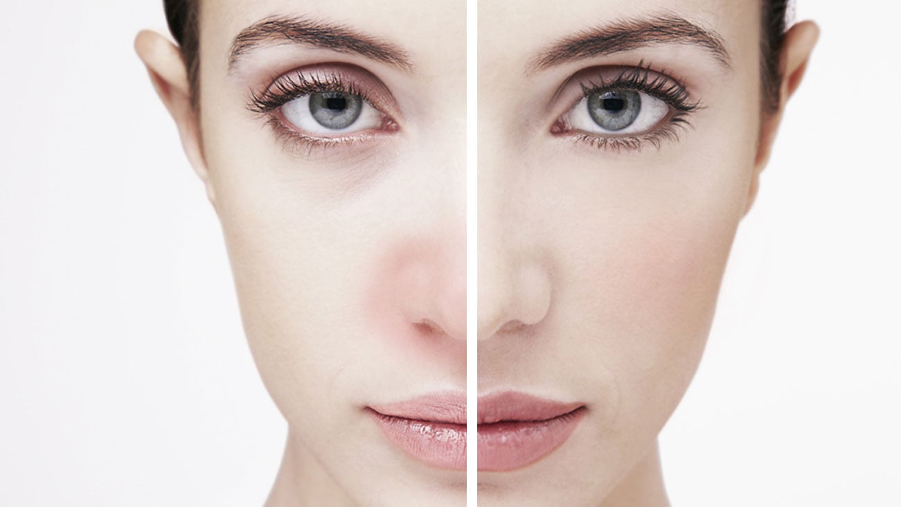 La cara de una mujer, la mitad cubierta con maquillaje para cubrir la irritación provocada por las alergias