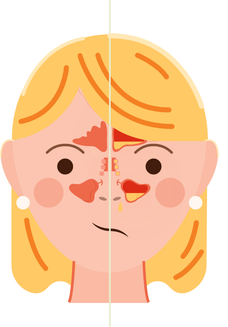 Diagram of woman showing healthy sinuses vs. sinusitis